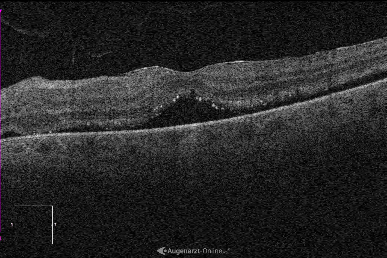 Ablatio retinae