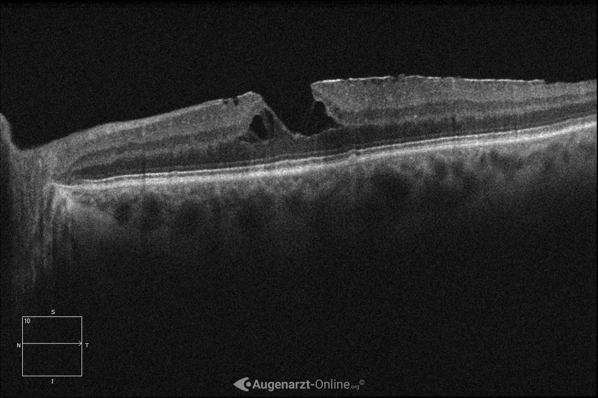 Pseudoforamen
