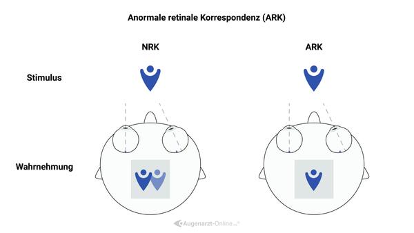 Anormale Retinale Korrespondenz