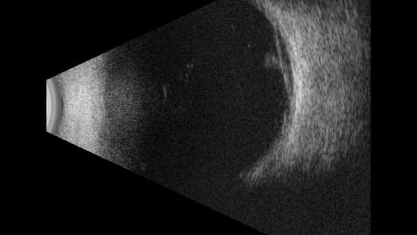 Netzhautforamen