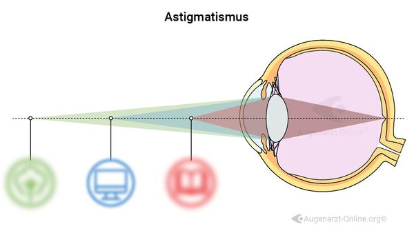 Astigmatismus