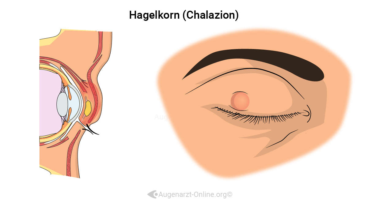 Hagelkorn