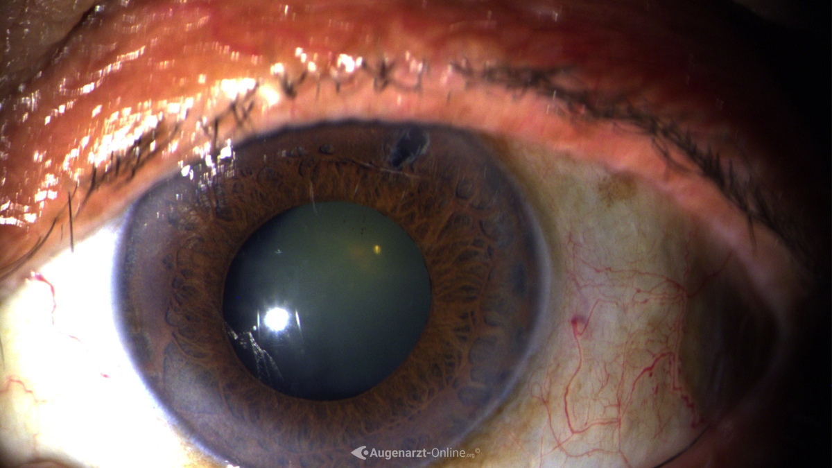 Iridotomie