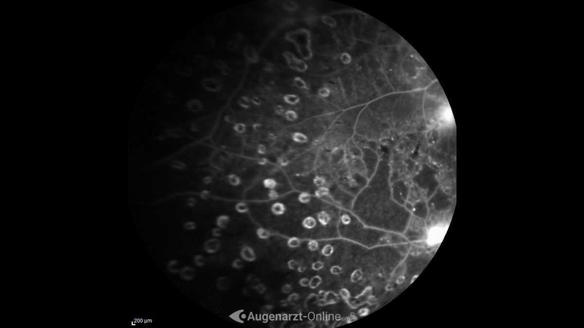 ALK Laser Herde