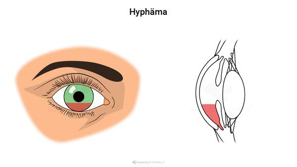 Hyphäma