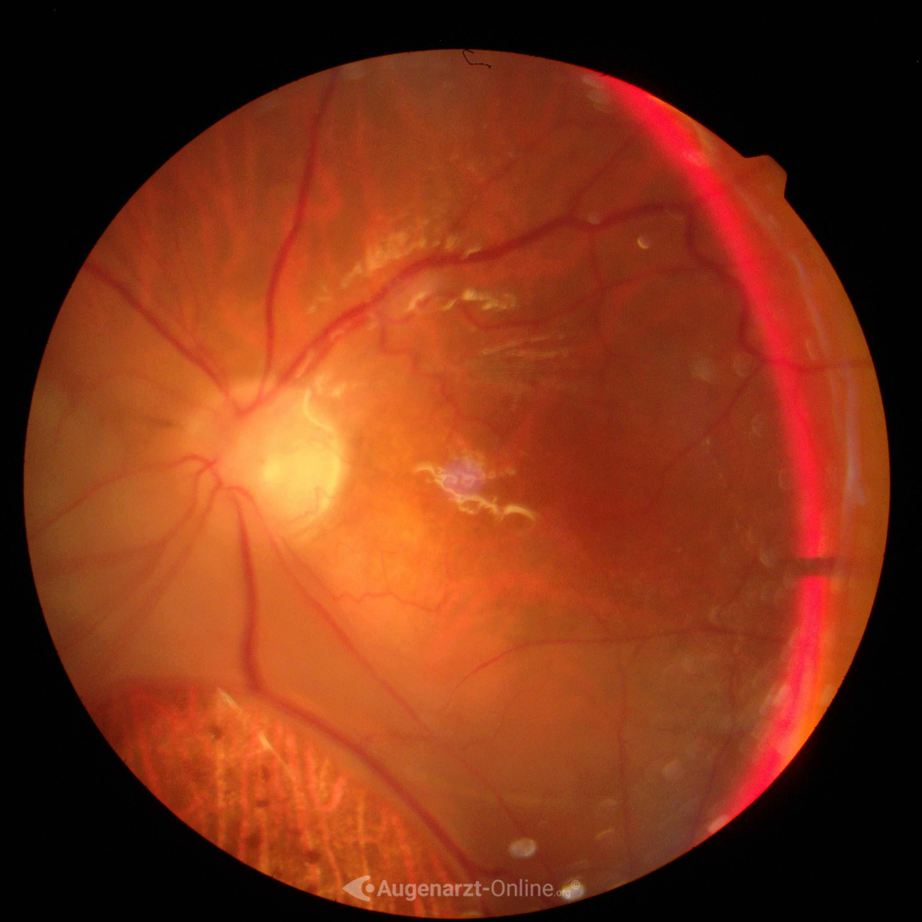Klinisches Bild (Fundusfoto) des linken Auges zu Ablatio retinae.