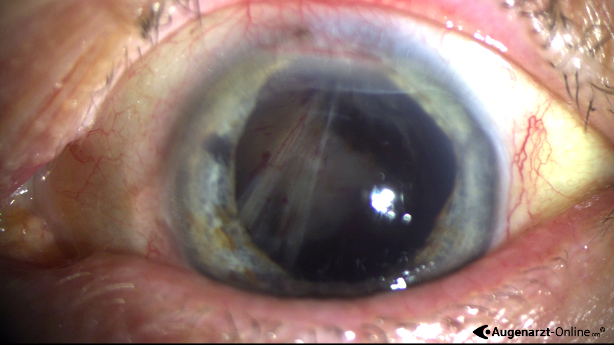 Ablatio retinae
