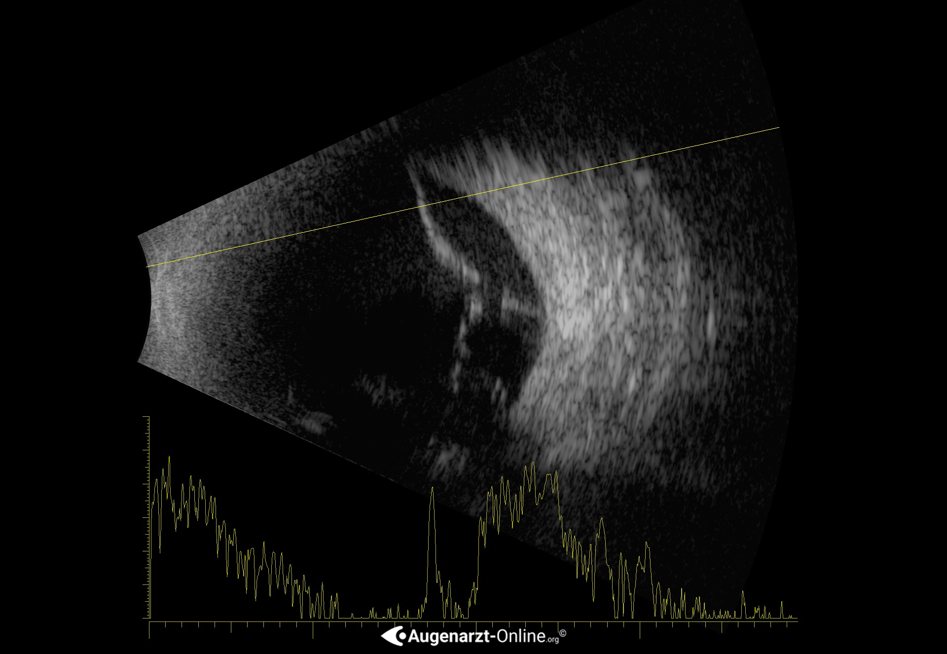 Ablatio retinae Glaskörperblutung