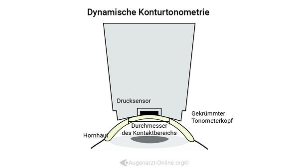 Tonometer - Dynamische Konturtonometrie