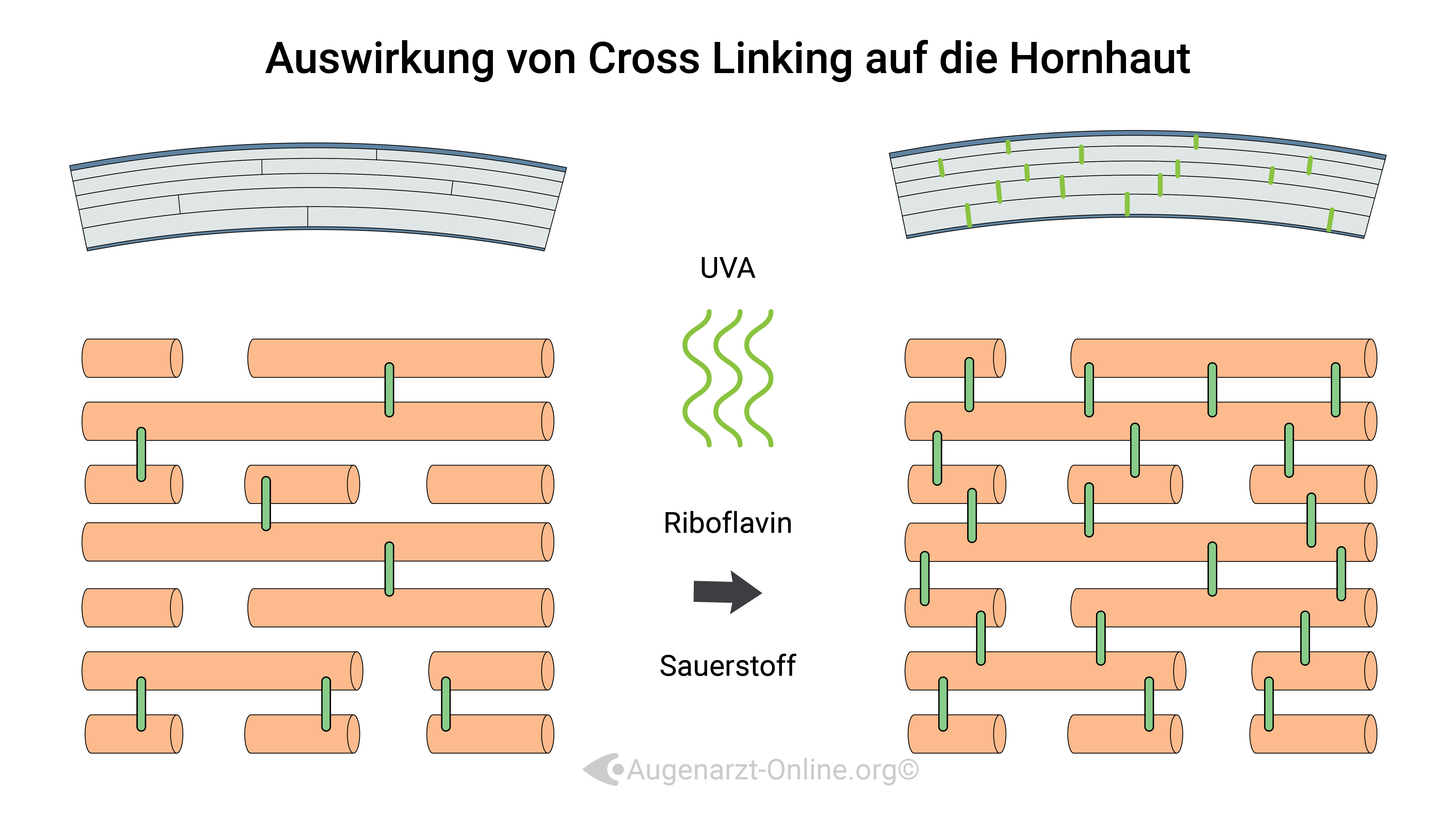 Corneal Cross Linking (CXL)