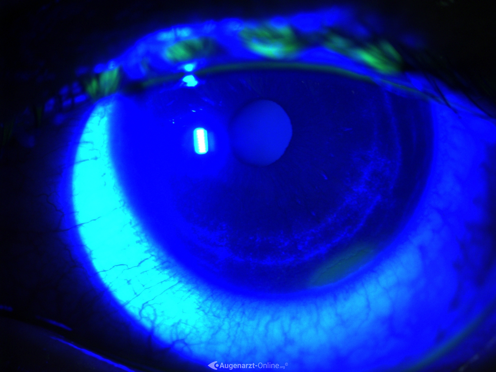 Erosio cornea