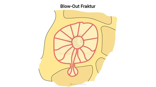 Blow-Out Fraktur