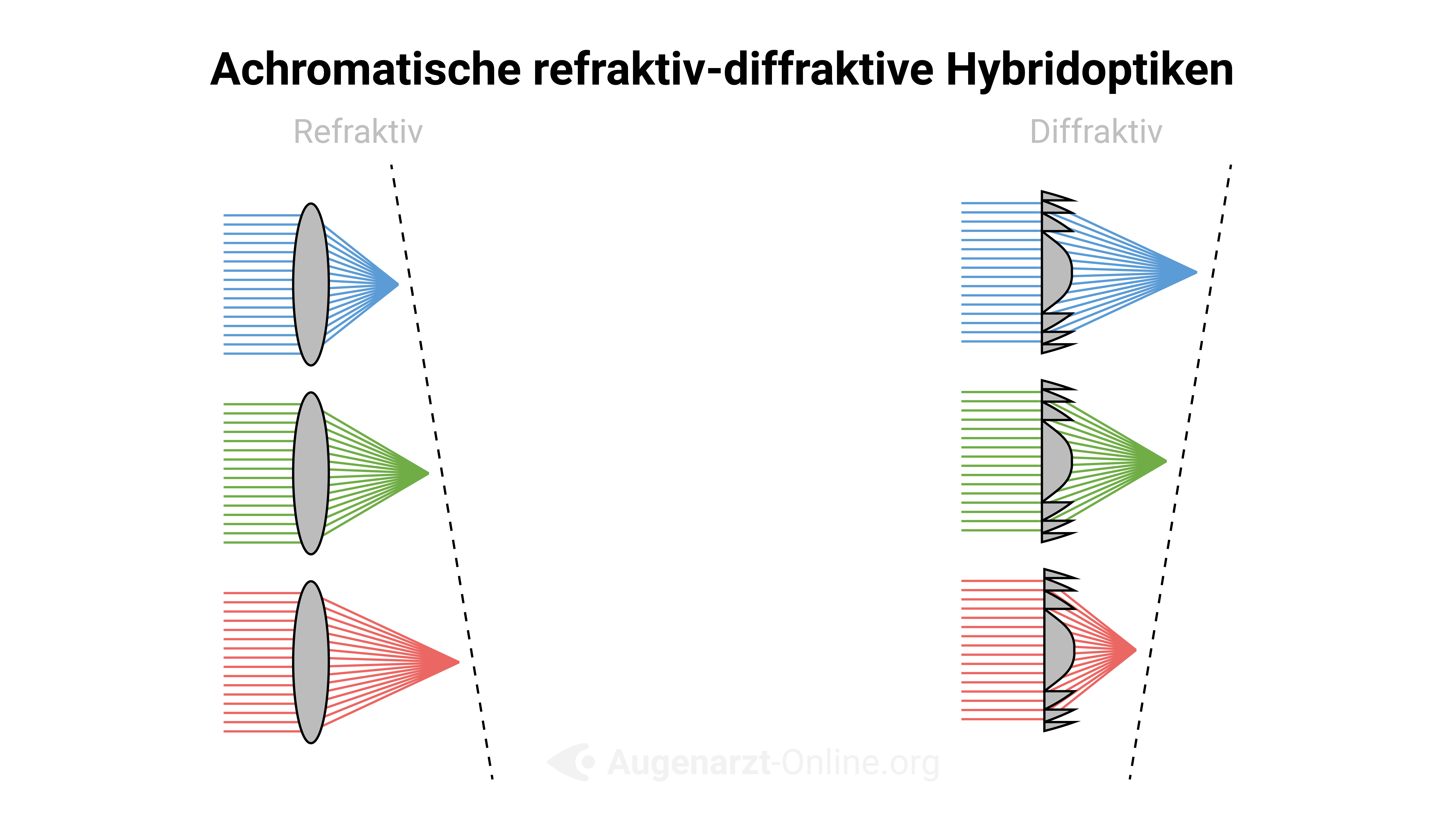 Multifokallinsen: refraktiv-diffraktive Hybridoptik