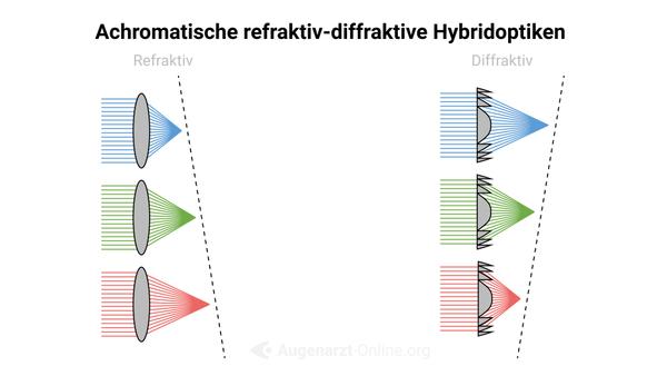 Multifokallinsen: refraktiv-diffraktive Hybridoptik