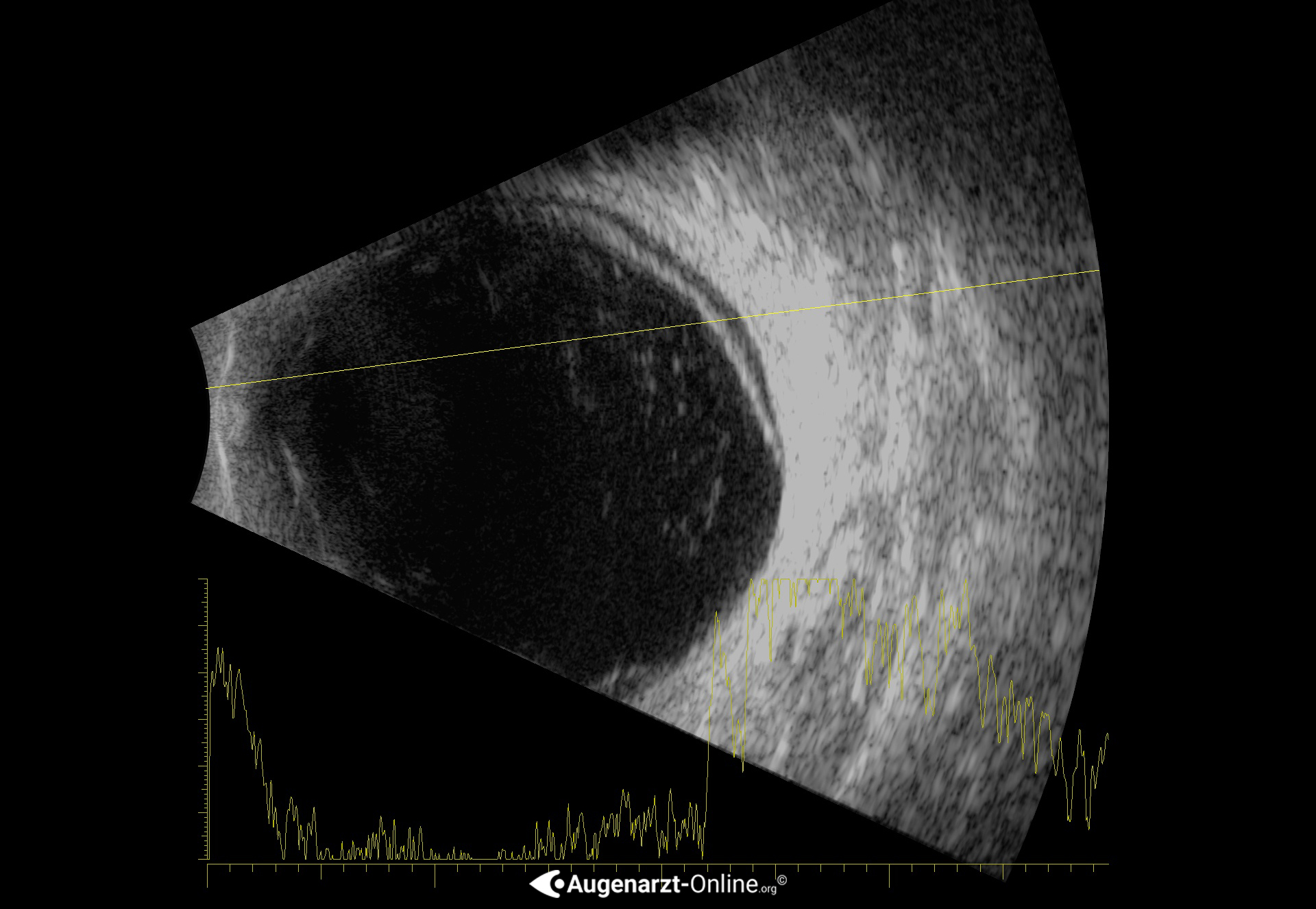 Ablatio retinae