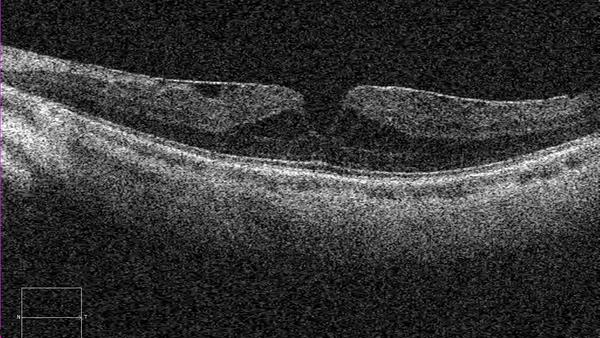 Pseudoforamen