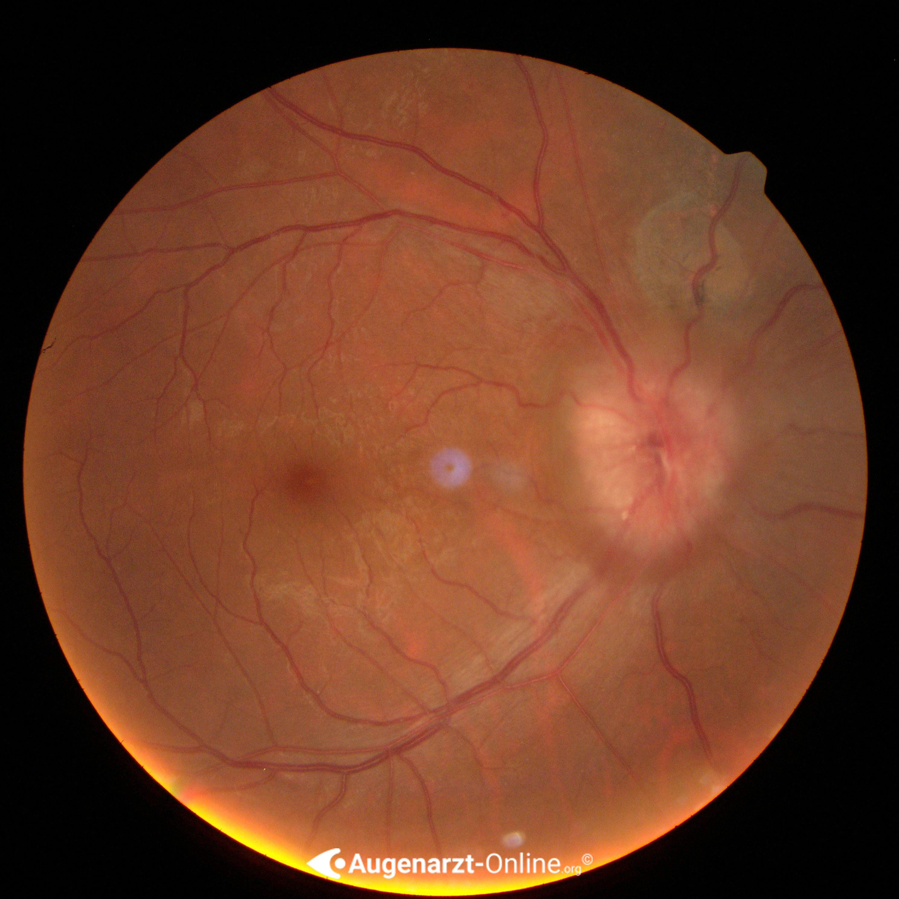 Hypertensive Papillenschwellung