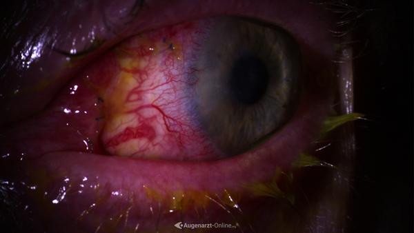Pterygium Transplantat