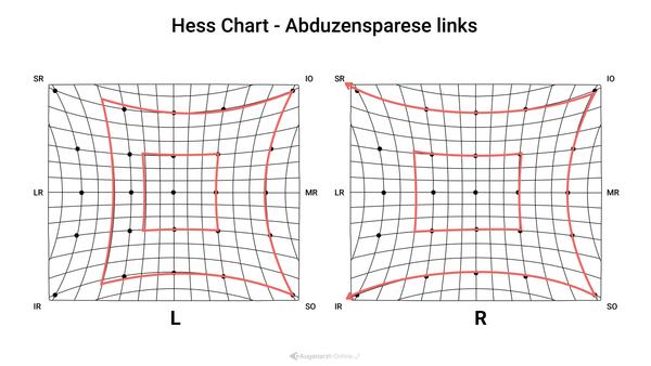 Hess Diagramm - Abduzensparese