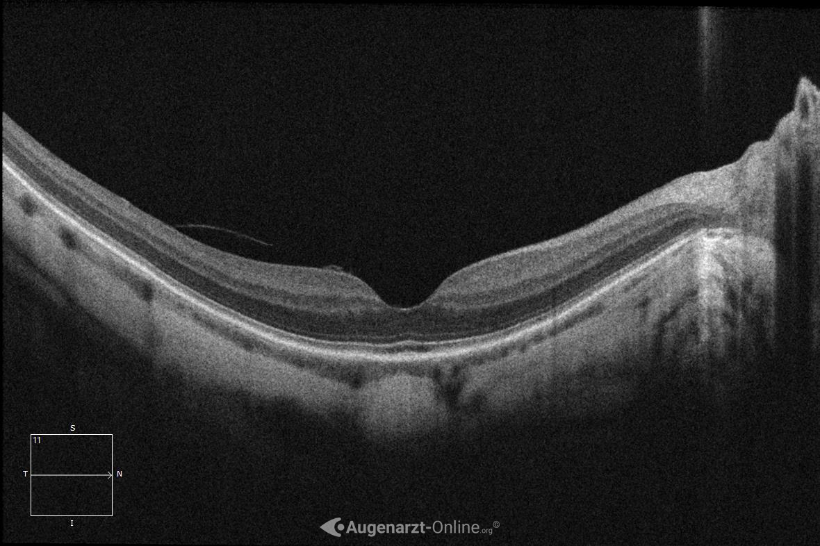 Myoper Fundus