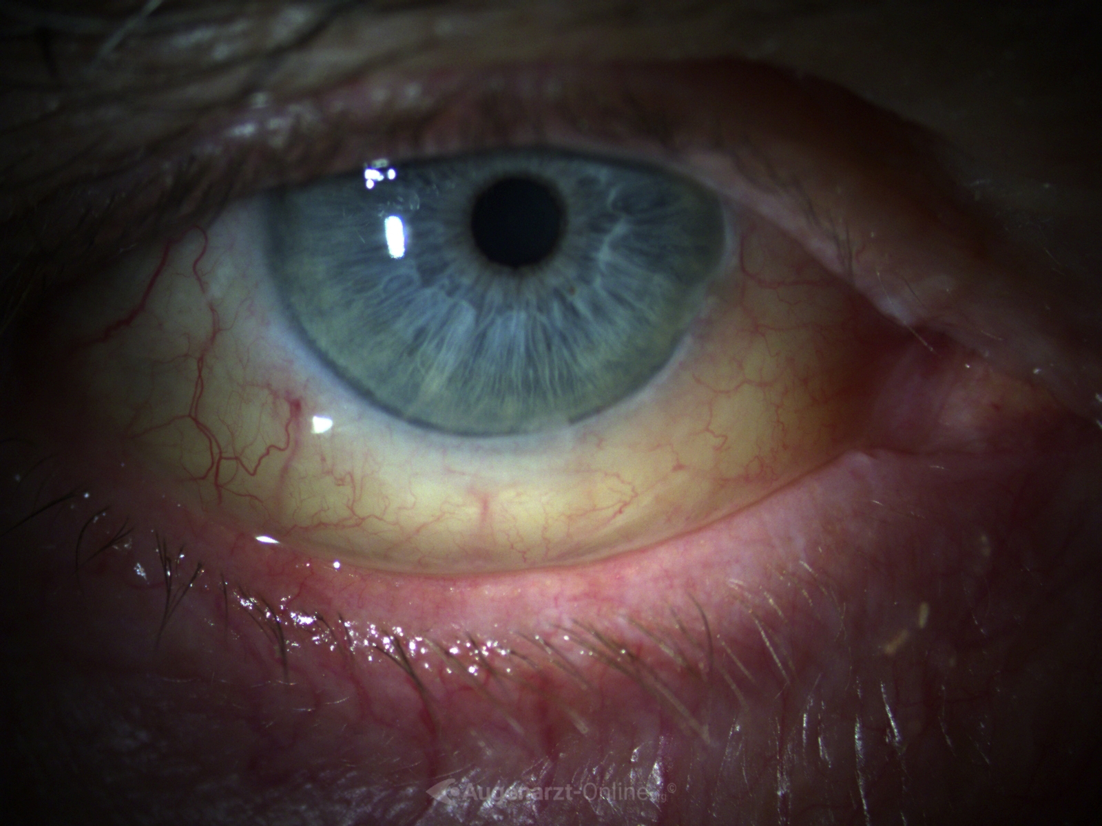 Medizinische Dokumentation: Bindehautzyste Differenzialdiagnose Lymphom (Spaltlampenfoto).