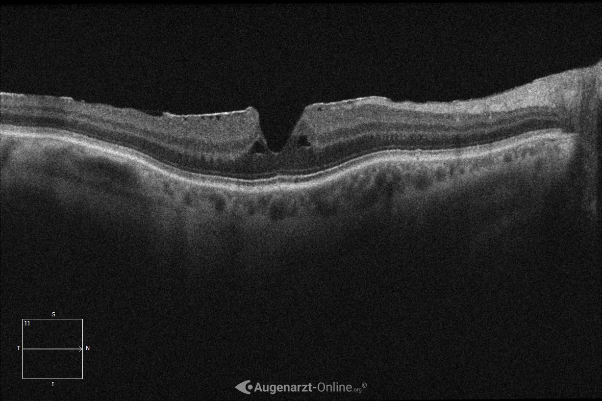 Pseudoforamen