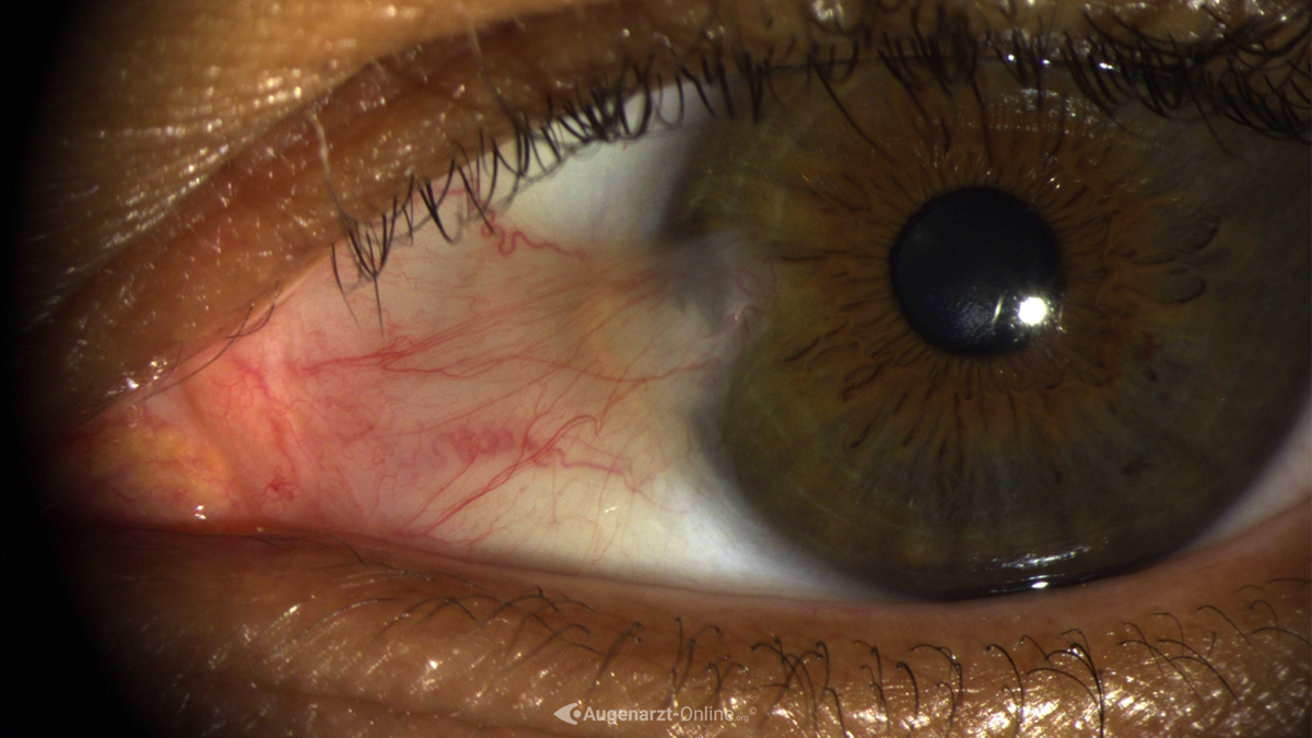 Flügelfell (Pterygium)