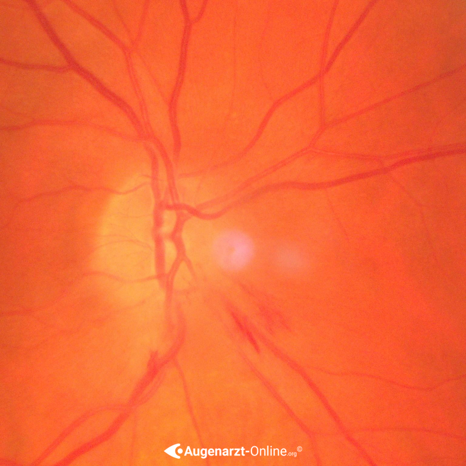 Nicht Arteritische Ischämische Optikus Neuropathie (NAION)
