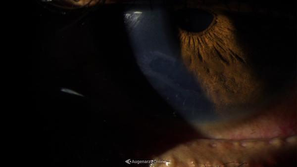 Erosio cornea