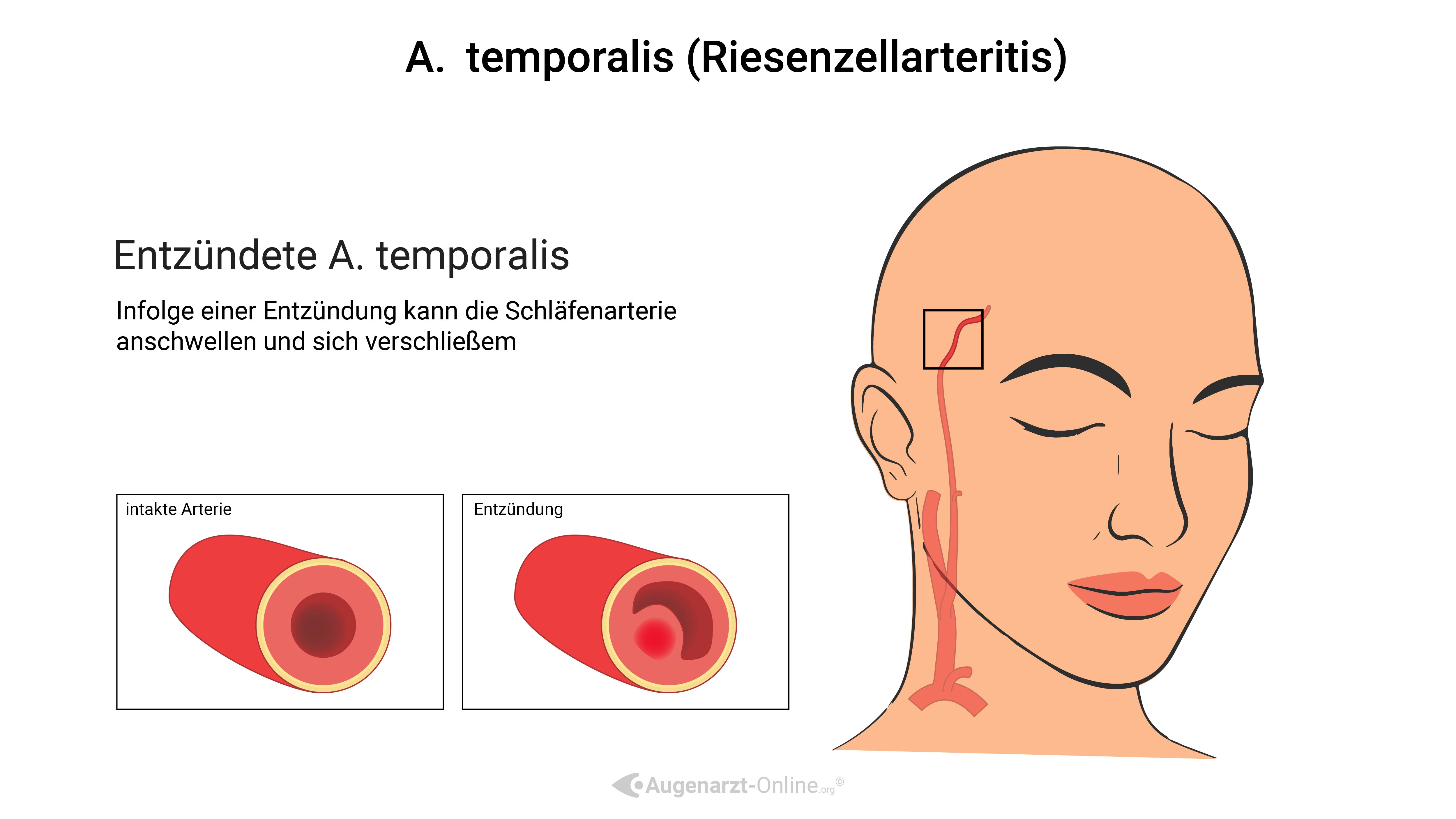 Arteritis temporalis