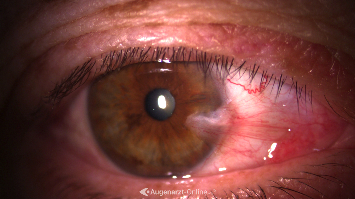 Pterygium