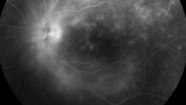 Nicht-arteriitisch bedingte anteriore ischämische Optikusneuropathie