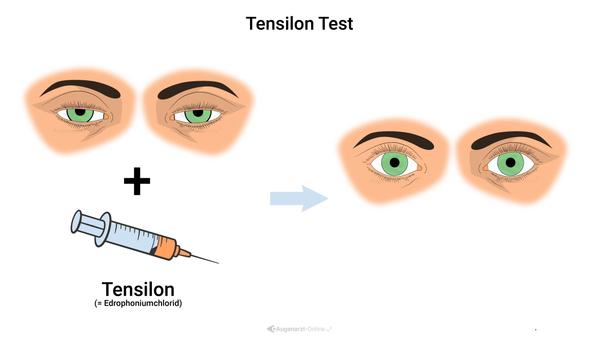 Tensilon Test