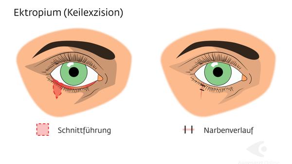 Ektropium Auswärtsdrehung des Unterlids