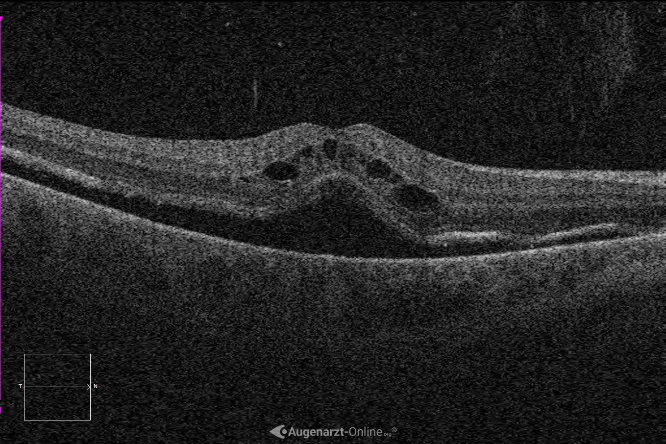 Ablatio Retinae (Makula Off)