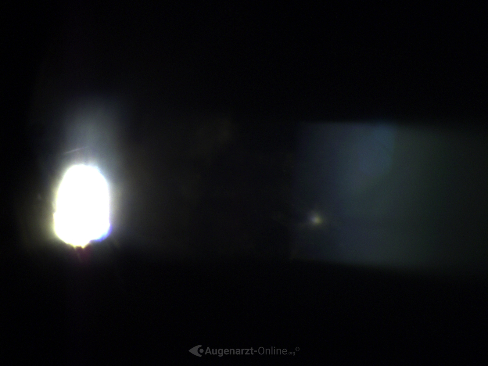 Fibrin bei Uveitis anterior (Tyndal) in Spaltlampenfoto.