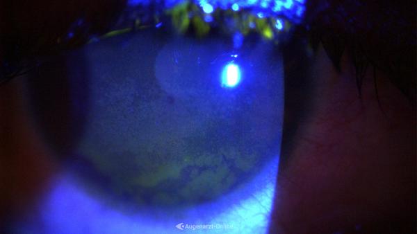 Keratitis superficialis punctata