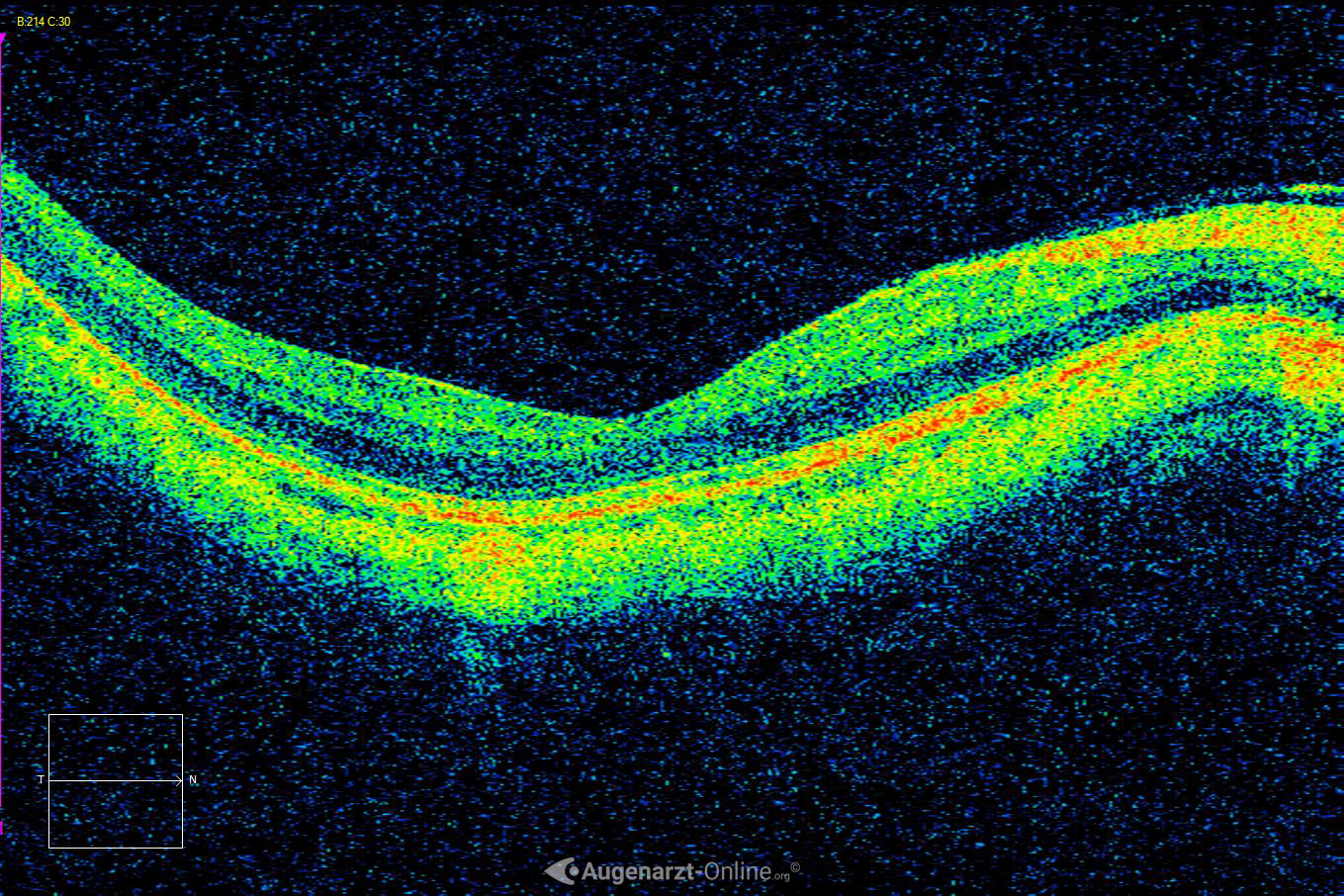 Myopie - Bulbus Elongation