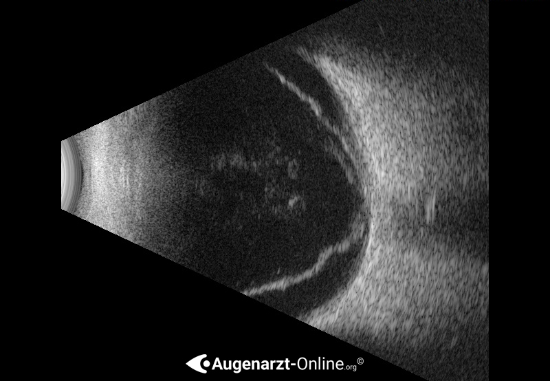 Ablatio Retinae