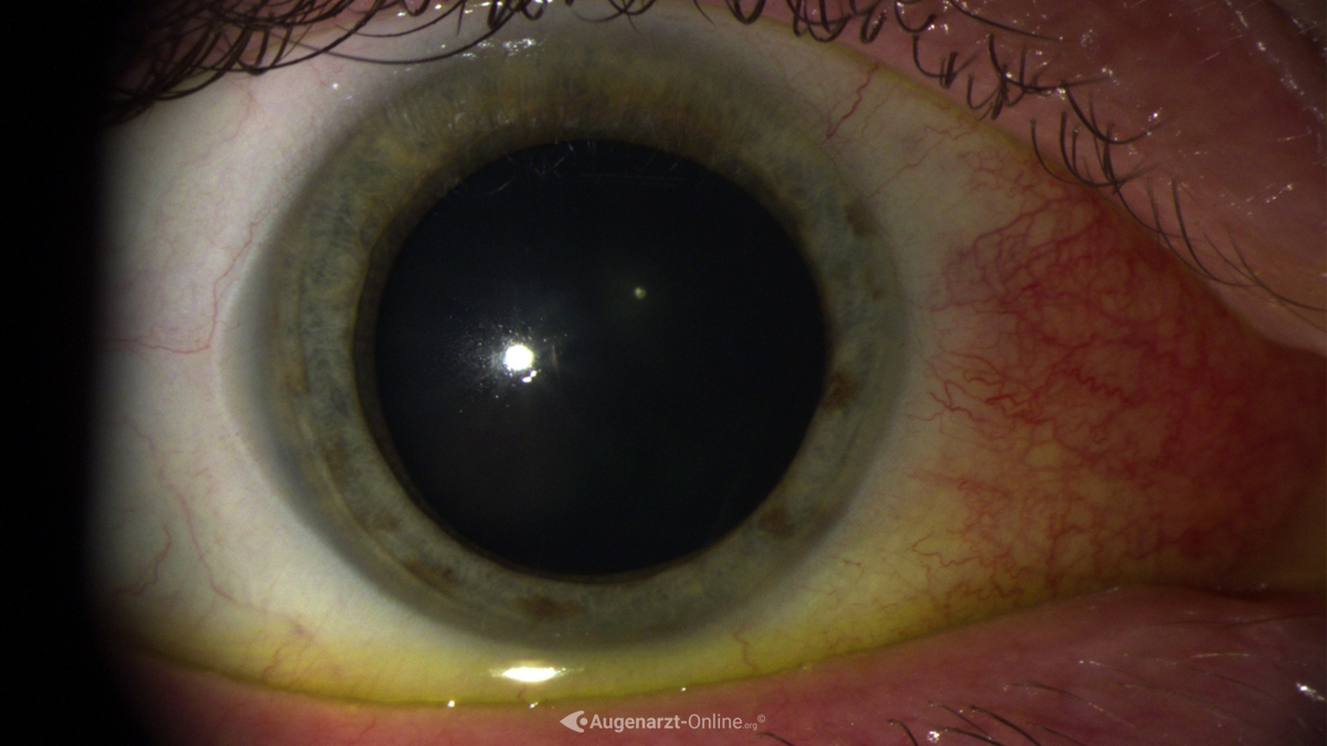 Episkleritis
