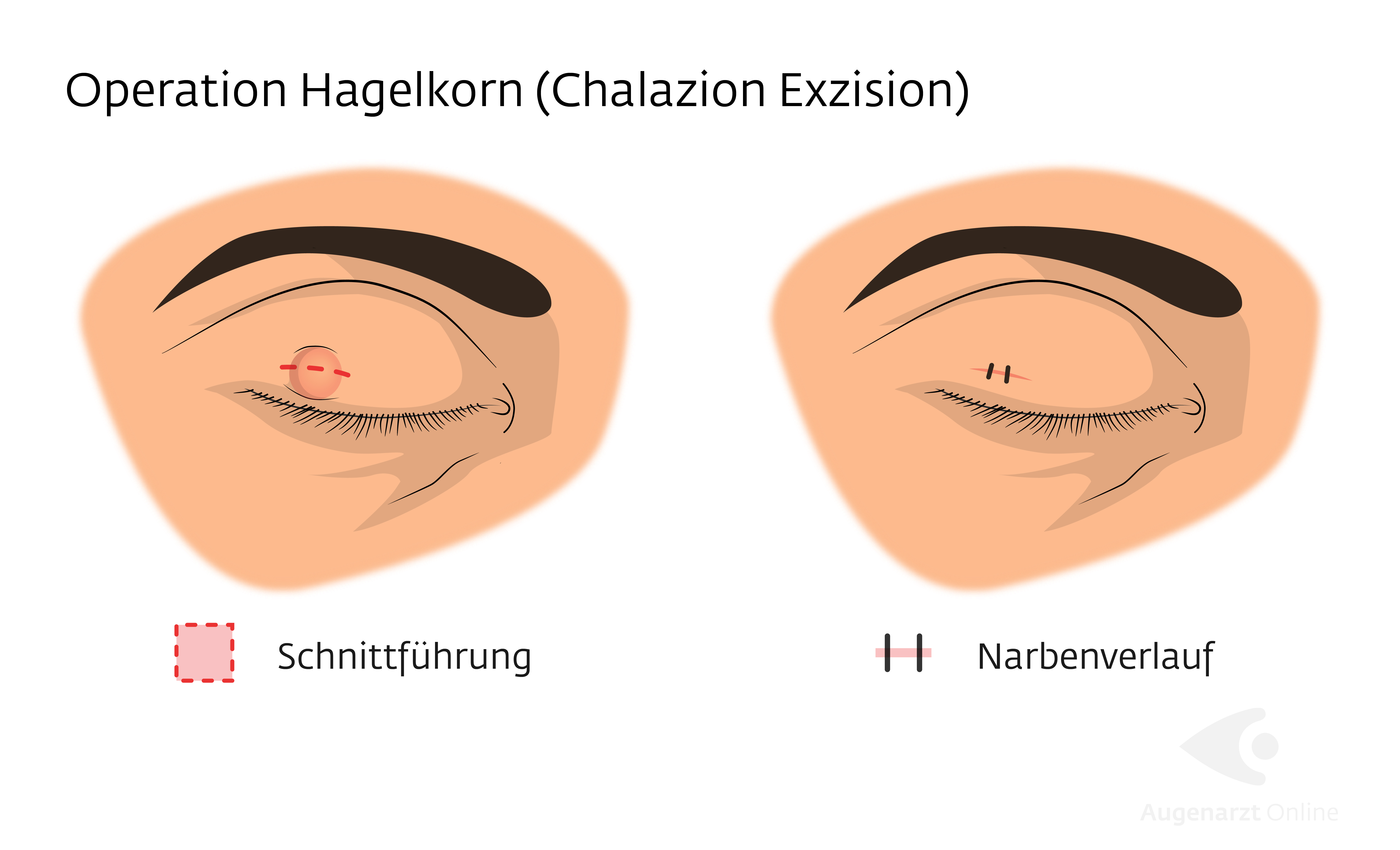 Hagelkorn (Chalazion): Operation Schritt für Schritt
