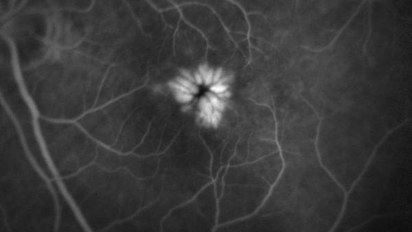 Cystoides Makulaödem (CME)