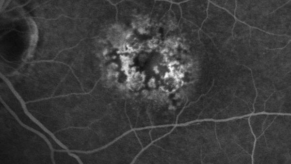 Patterndystrophie