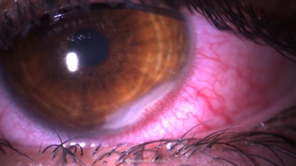 Marginale Keratitis