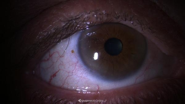 Trichiasis
