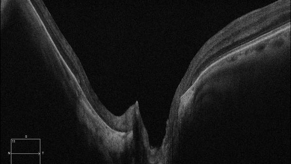 Medizinische Dokumentation: Staphylom bei Myopie (OCT).
