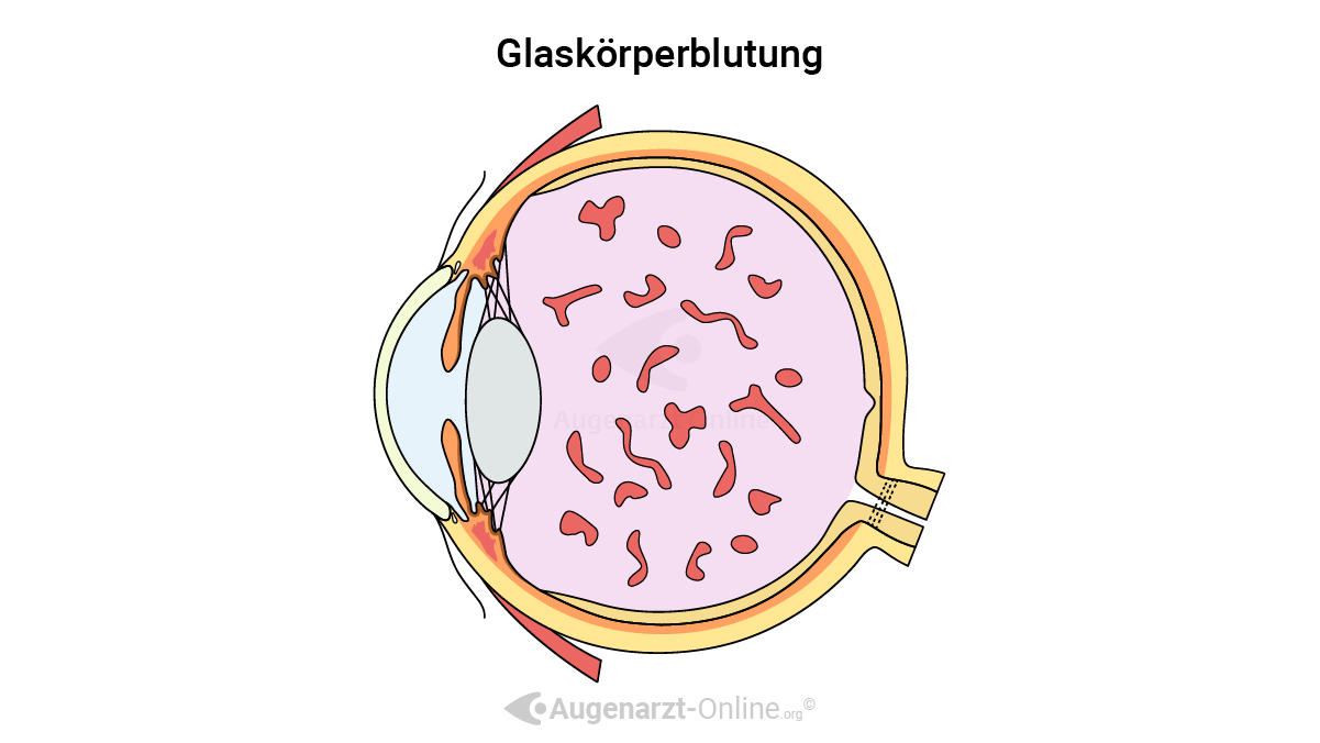 Glaskörperblutung