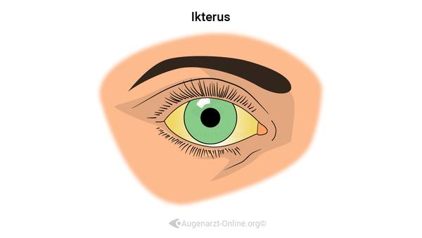 Ikterus