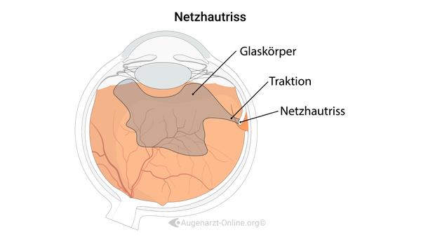 Netzhautriss