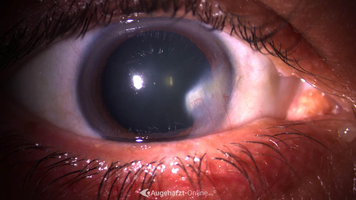 Pterygium